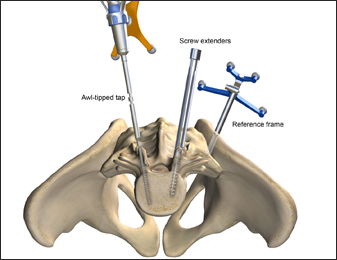 Stereotactic, Wireless, Percutaneous Pedicle Screw Placement
