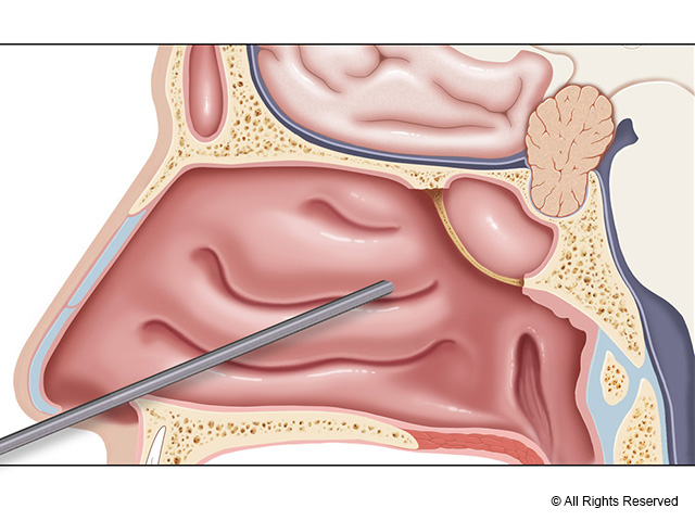 Nasal access for instruments during endoscopic transsphenoidal pituitary surgery.