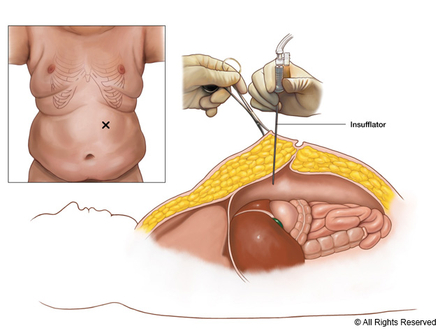Abdominal insufflation in preparation for laparoscopic bariatric surgery.