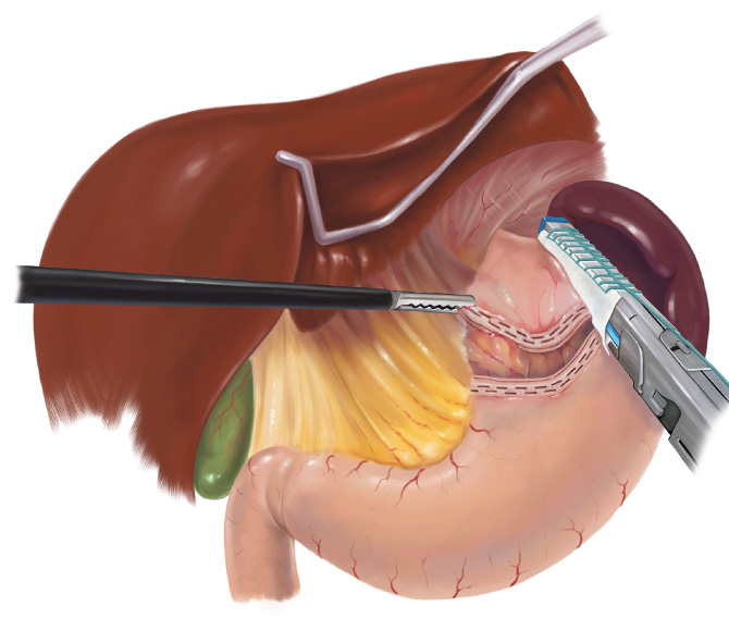 Creating the gastric pouch in an Roux-en-Y gastric bypass.