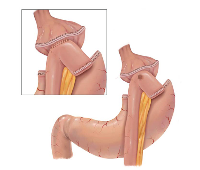 Complete Roux-en-Y gastric bypass.