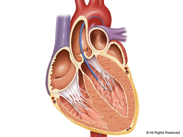 Illustration of Millar's Mikro-Cath Pressure Catheter.