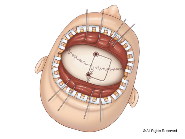 Craniotomy for transcallosal approach.