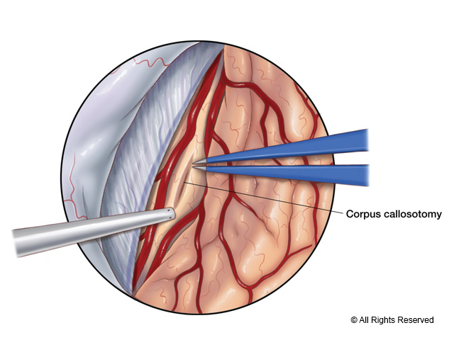 Exposure of the corpus callosum and callosotomy.