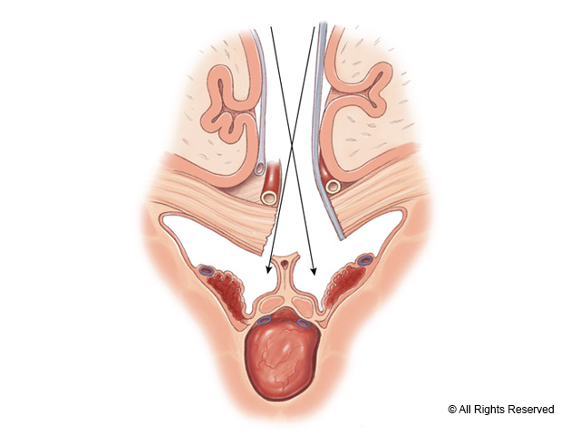 Transchoroidal approach for intraventricular tumors.