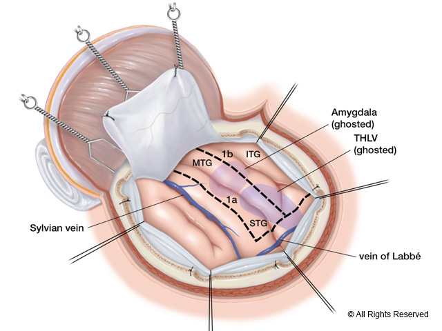 Craniotomy: Exposure of STG, MTG, ITG
