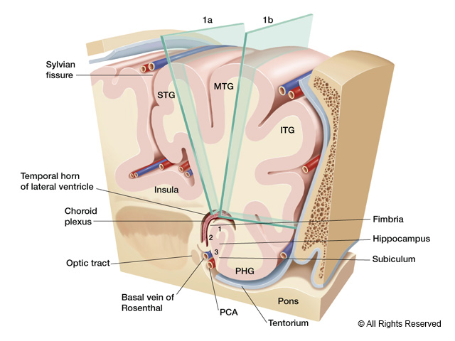 Surgical approach for hippocampectomy.