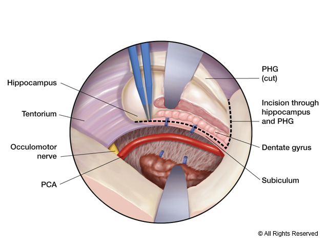 The parahippocampal gyrus is resected to gain space to remove the hippocampus.