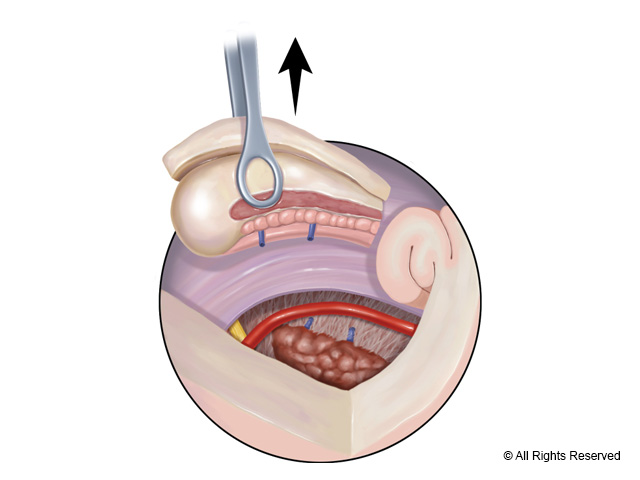 Removal of hippocampus en bloc.