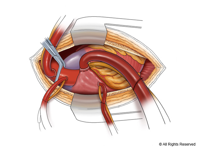 Surgeon’s view of the heart after cannulation.