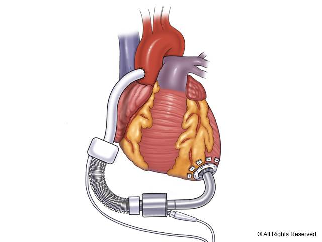 An axial flow left ventricular assist device