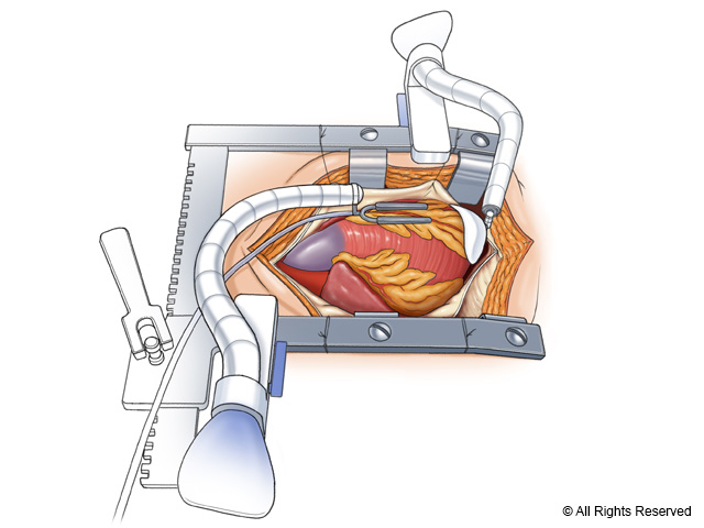 Off-pump coronary bypass using vacuum-assisted multiarticulating arms for myocardial positioning and stabilization.
