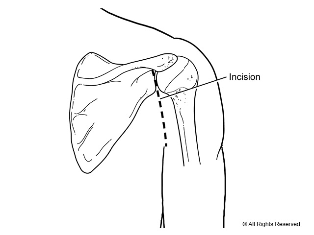Incision site for posterior shoulder instability surgery.