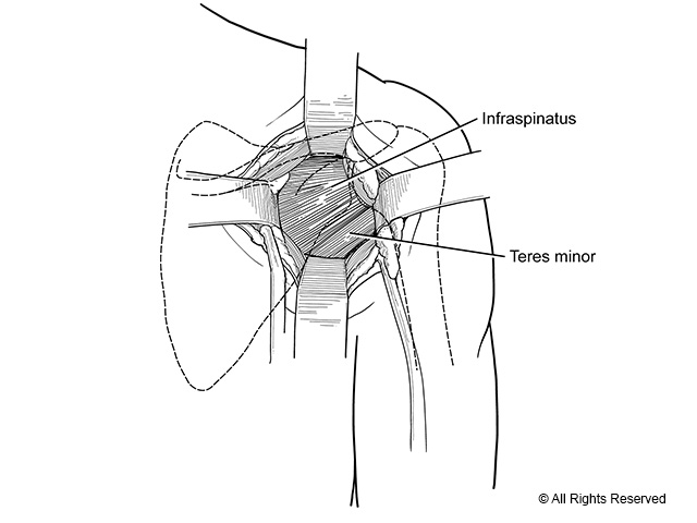 Dissection to visualize the the teres minor and the infraspinatus.