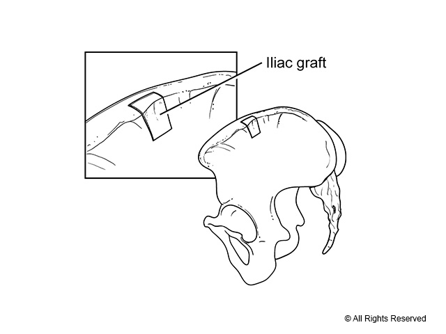Iliac crest bone graft is taken from the superior and lateral cortices.