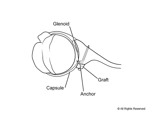 Axial view of the bone graft after it has been secured to the glenoid face.