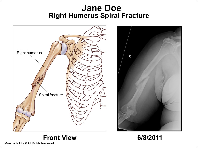 Spiral fracture of the right humerus.