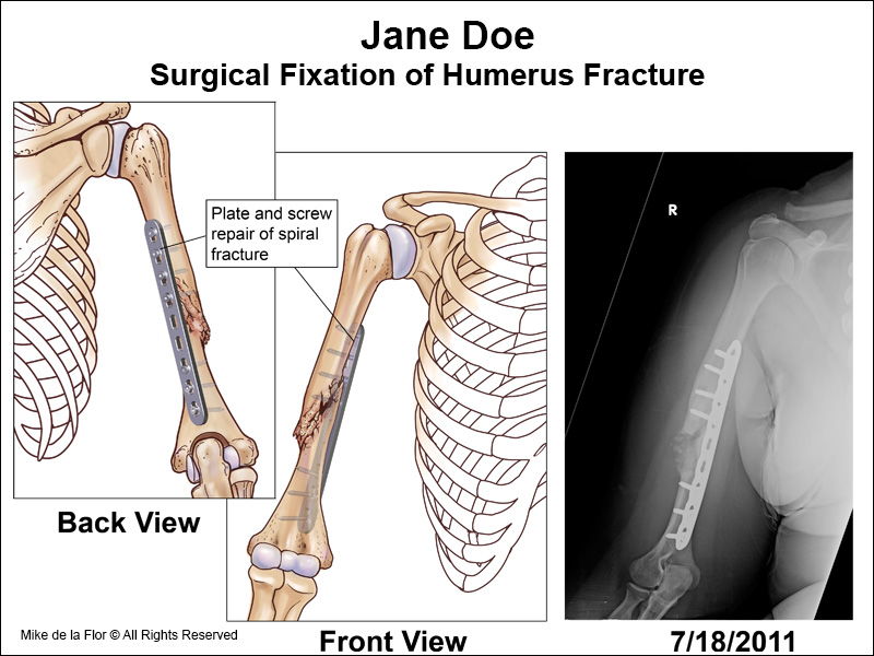 Surgical fixation of spiral fracture.