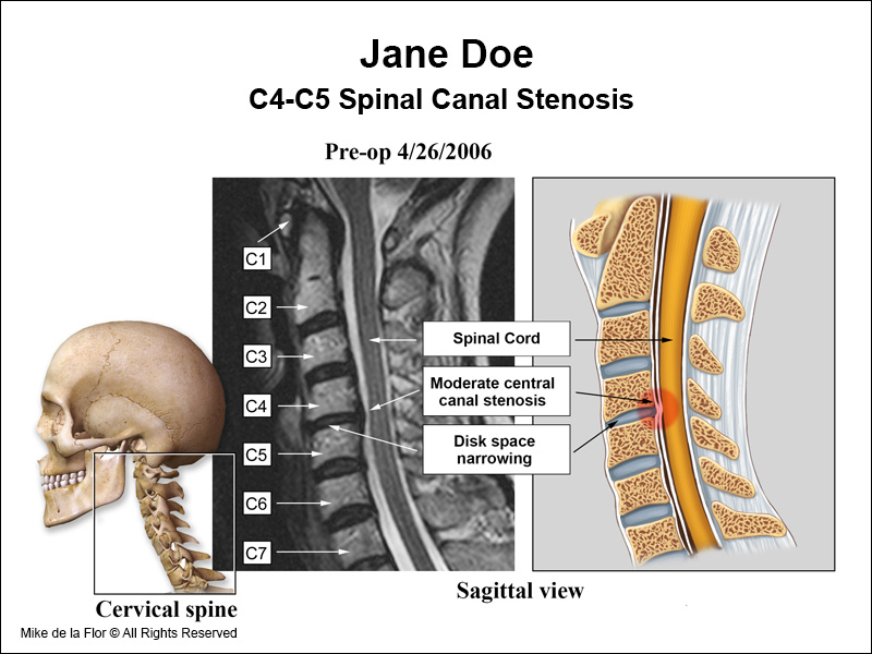 C4-C5 spinal canal stenosis.