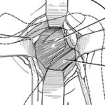 Posterior shoulder instability.