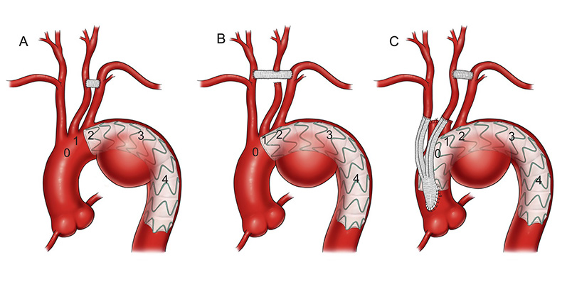 Aortic arch vessel debranching.